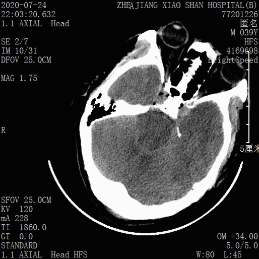 急诊头颅ct.gif