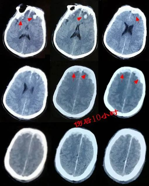 顱腦ct(傷後10小時)可見:雙側額葉腦挫裂傷,雙額硬膜下血腫較傷後5