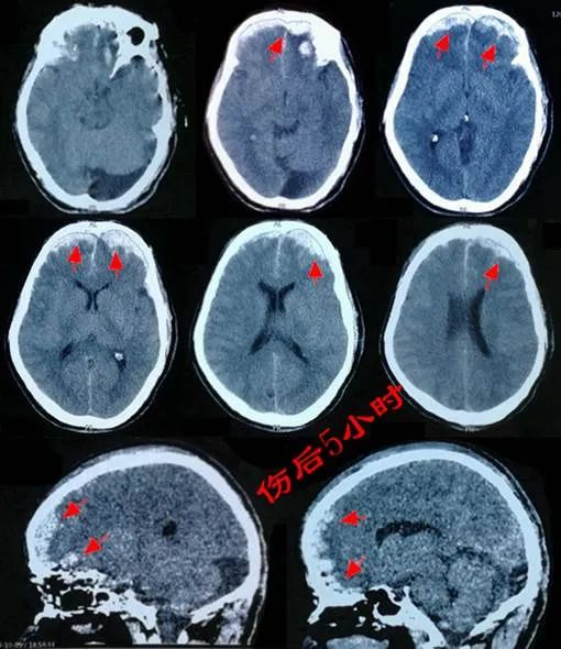 顱腦ct(傷後10小時)可見:雙側額葉腦挫裂傷,雙額硬膜下血腫較傷後5