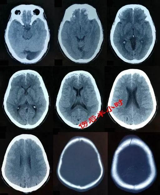 顱腦ct(傷後10小時)可見:雙側額葉腦挫裂傷,雙額硬膜下血腫較傷後5