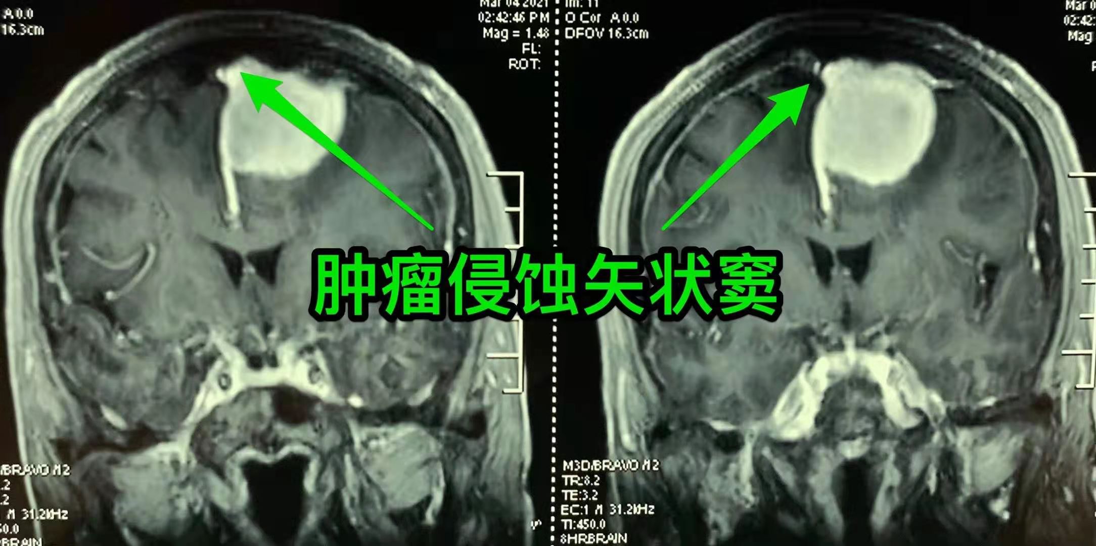 病例306 慢性上颌窦炎-X线读片-医学