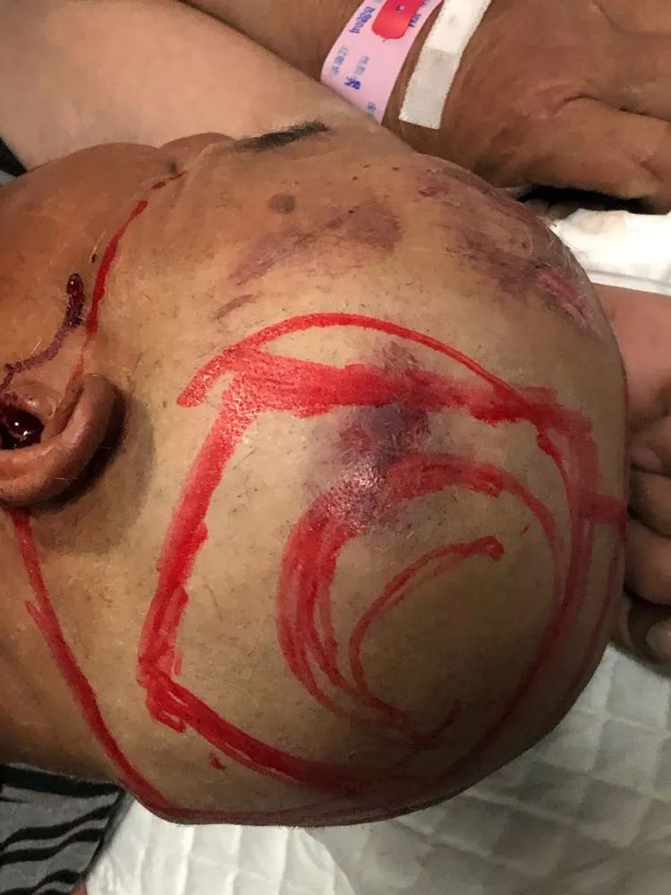 重型颅脑损伤双侧去骨瓣减压血肿清除一例