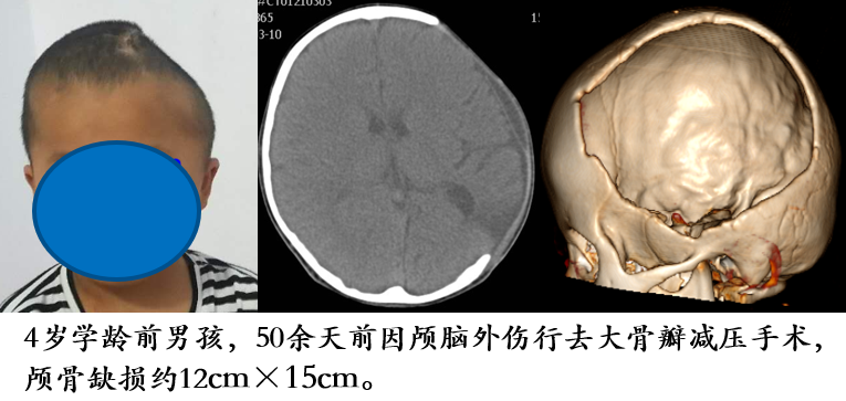 體提示頭顱畸形,左側額顳頂部顱骨缺損,入院完善顱腦三維ct檢查(圖1)