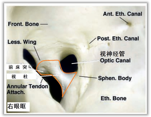 前床突磨除技术(下篇)