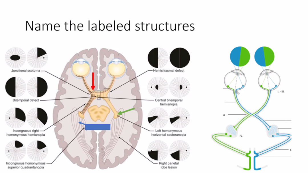 由于患者有双颞侧偏盲症状,带教老师引导学员对视觉通路及视路不同