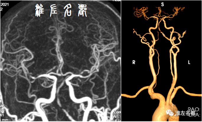 脑血管mra解剖图图片