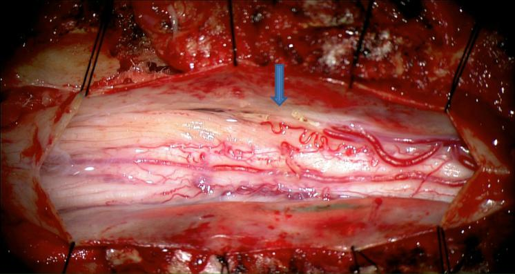 nexus手术技巧丨第七十八期胸腰段椎板切除术合并左t12动静脉瘘切除术