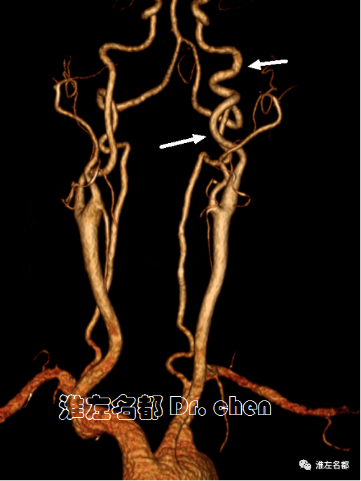 闭孔动脉CT图片