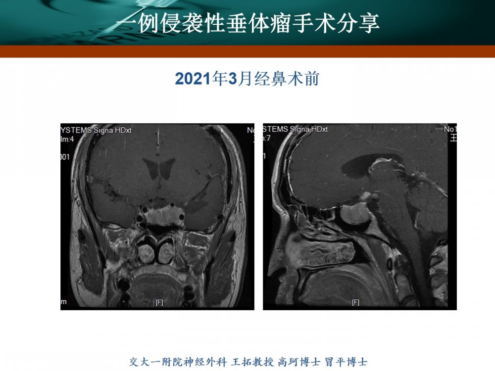 王拓教授團隊一例侵襲性垂體瘤手術分享