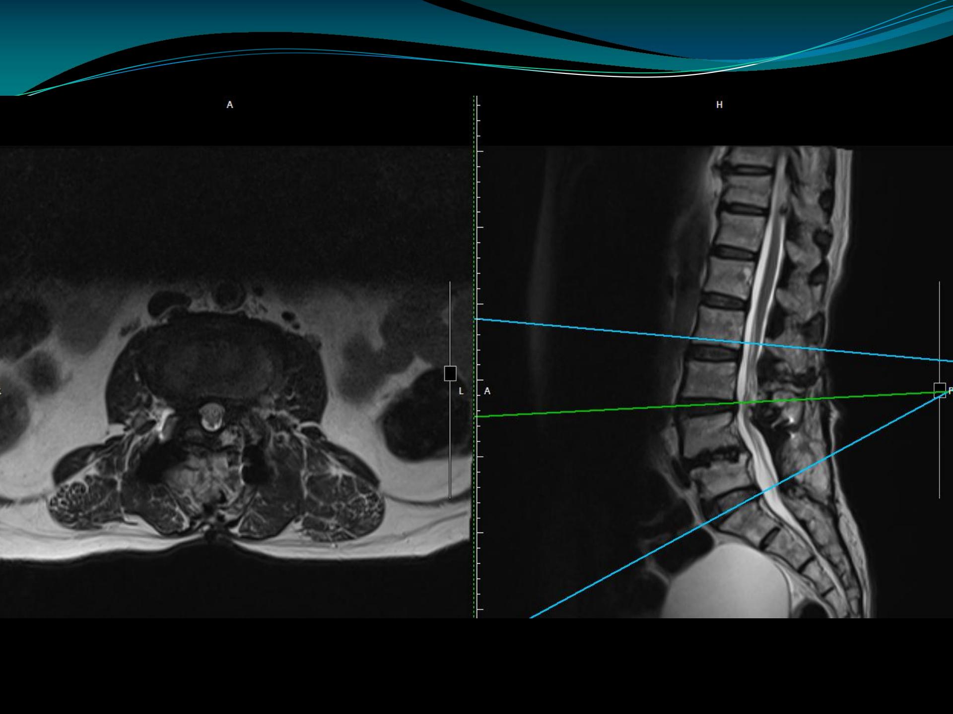 神外青年医师脊柱系列丨腰椎间孔狭窄内镜手术治疗理论与实践