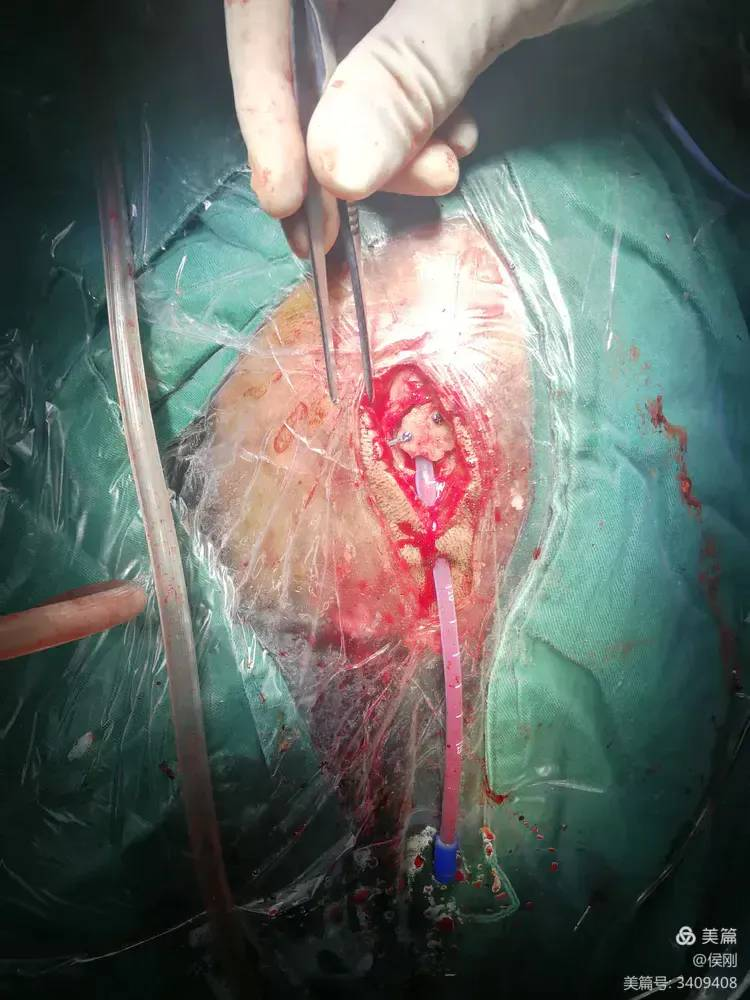 内镜辅助下高血压脑出血清除术