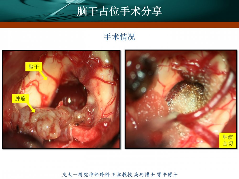 王拓教授团队脑干占位手术分享