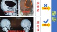 颅骨修补有没有必要？什么时机修补最好？什么材料最合适？手术有没有风险？