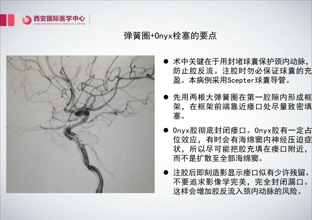 颈内动脉海绵窦瘘图片