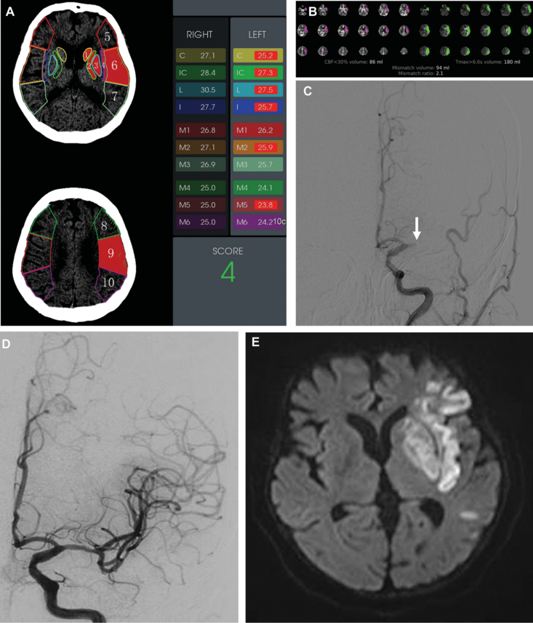较高的基线皮层aspects评分预测低aspects患者血管内治疗的良好预后