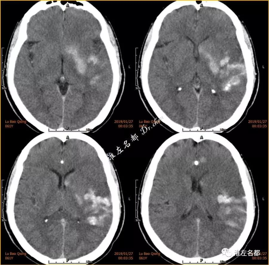 腦缺血介入治療後ct顱內異常高密度出血還是造影劑滲出