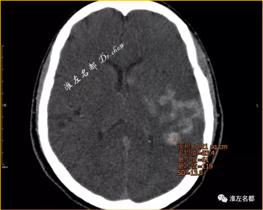 介入治療後即刻ct:左側基底節和左側顳頂葉多發高密度△dsa:取栓後