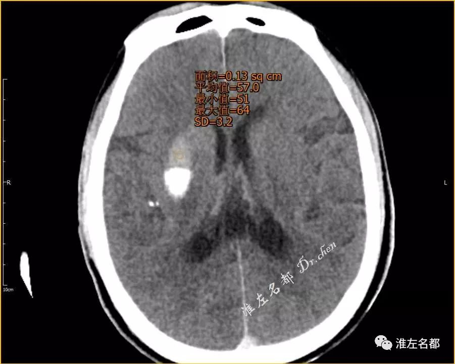 腦缺血介入治療後ct顱內異常高密度出血還是造影劑滲出