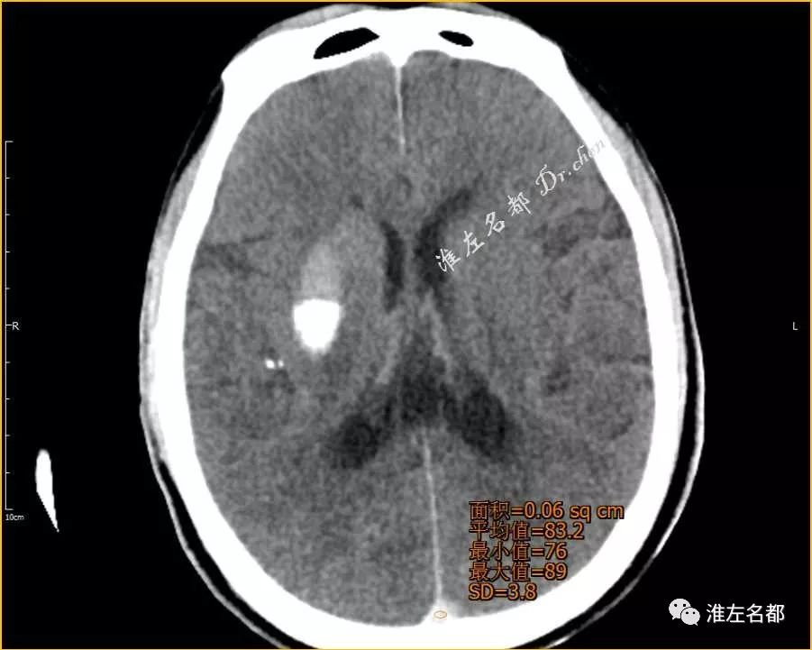 腦缺血介入治療後ct顱內異常高密度出血還是造影劑滲出