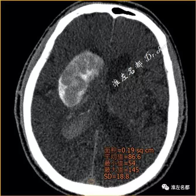 與前兩圖同一層面):上矢狀竇ct值86hu△術後第二日ct:右側基底節區和