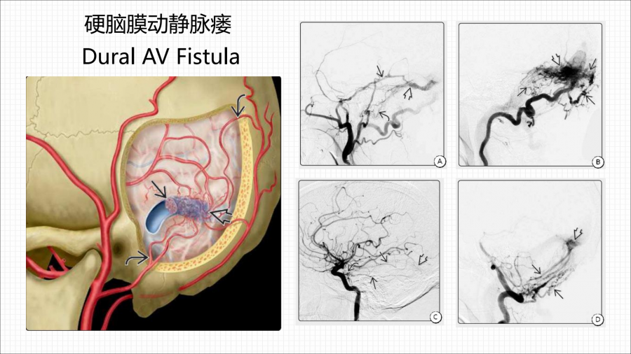 硬脑膜动静脉瘘的介入治疗_01.png