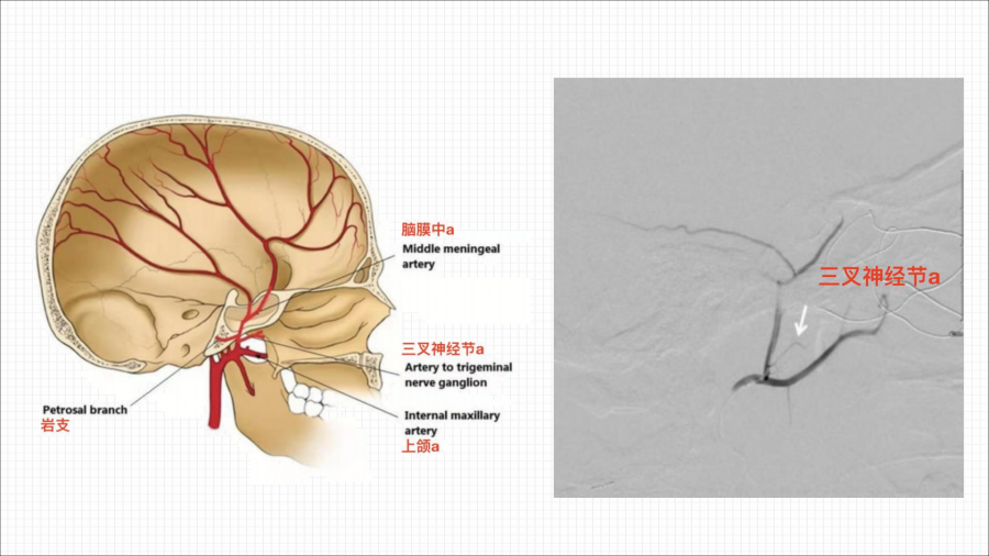 硬脑膜动静脉瘘的介入治疗_21.png