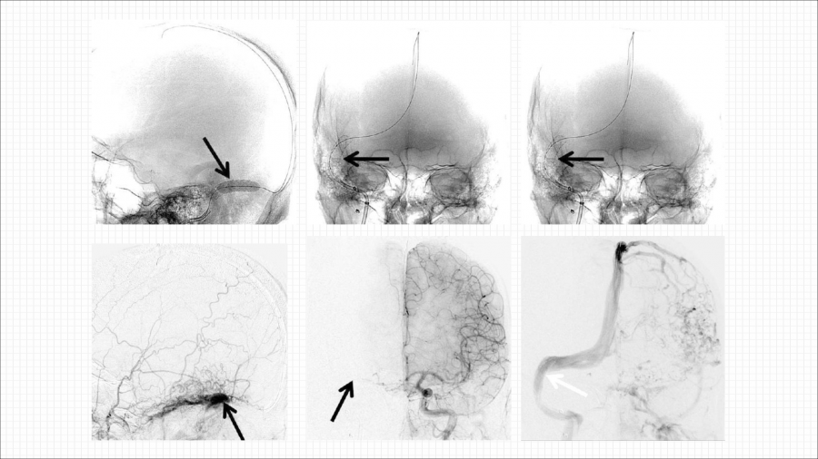 硬脑膜动静脉瘘的介入治疗_36.png
