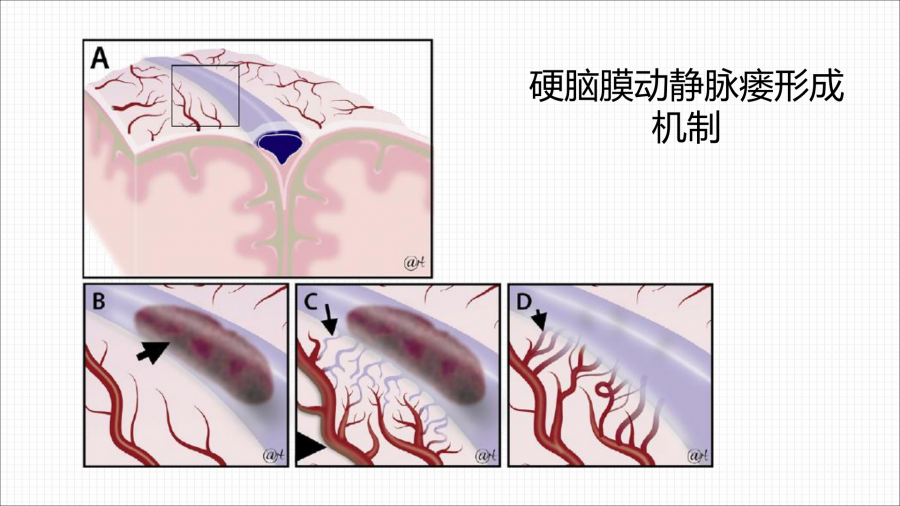 硬脑膜动静脉瘘的介入治疗_17.png