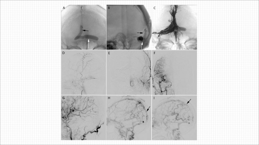 硬脑膜动静脉瘘的介入治疗_23.png