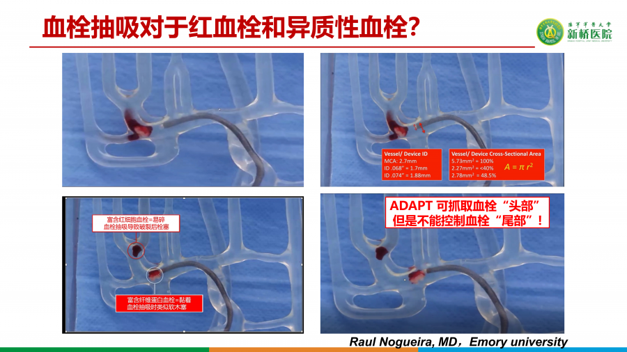 如何精准选择支架取栓术或ADAPT技术_05.png