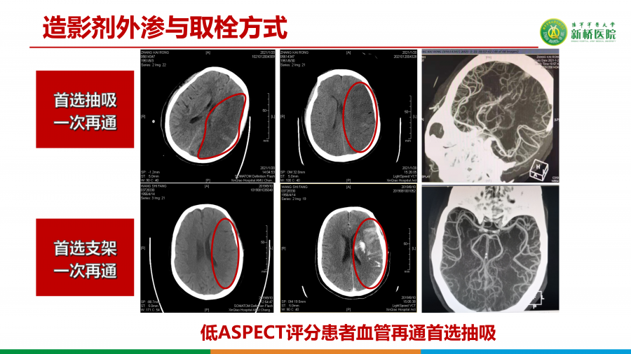 如何精准选择支架取栓术或ADAPT技术_29.png