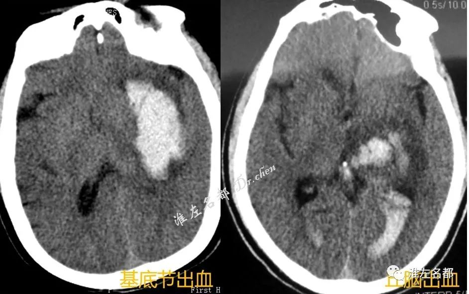 影像學檢查在原發性腦出血診治中發揮重要作用,計算機斷層成像(ct)最