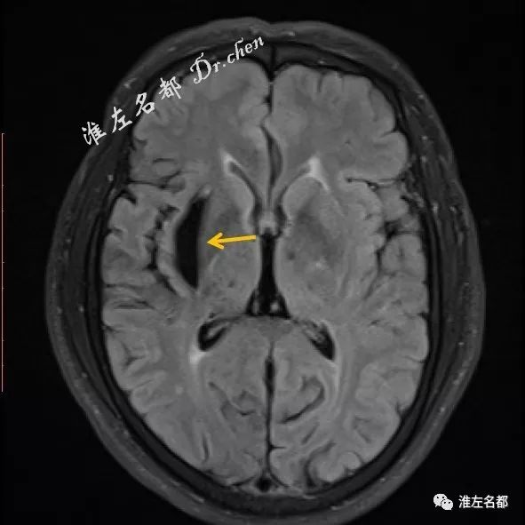 基底节区脑软化灶图片