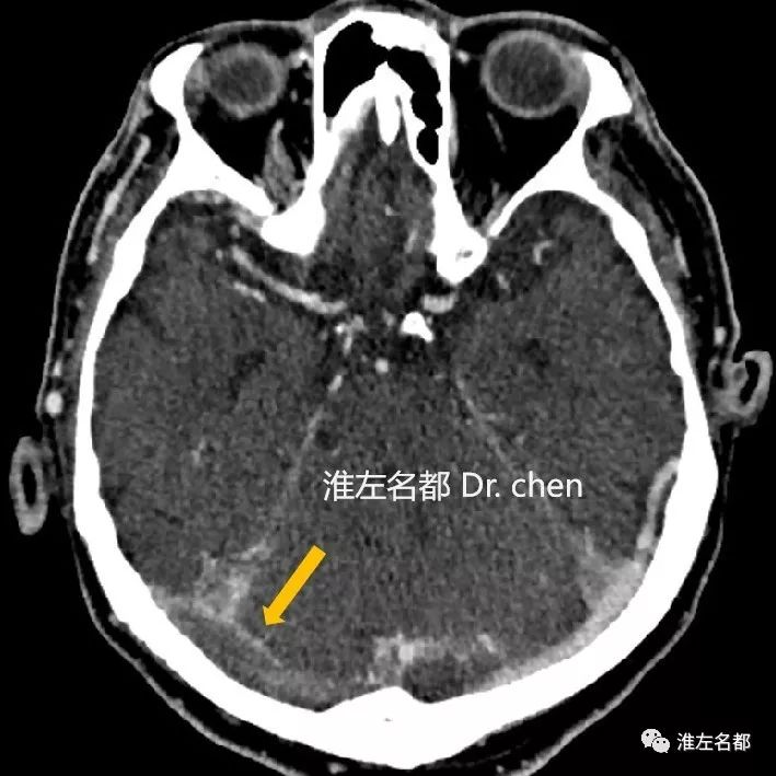 额窦CT图片图片