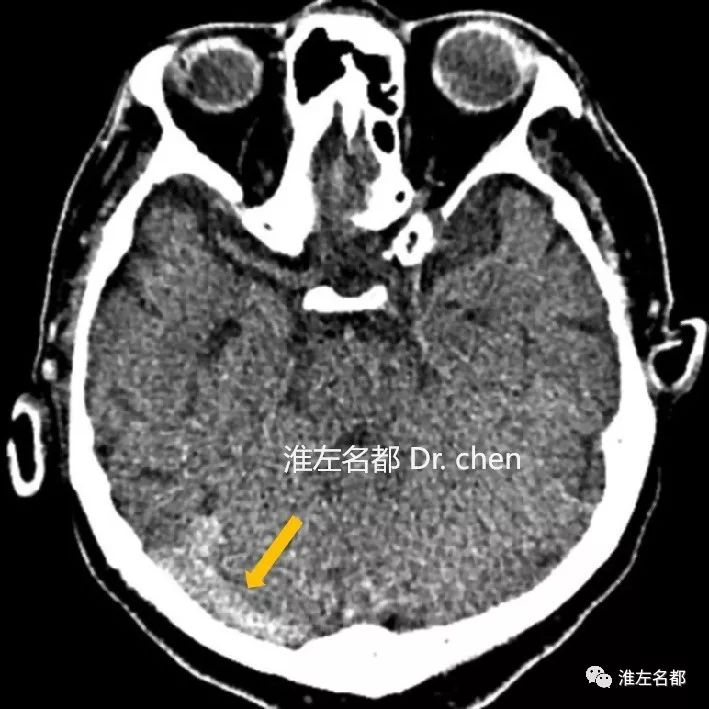 ct平扫薄层图像:右侧横窦走行位置条索状高密度影(橙箭),提示急性