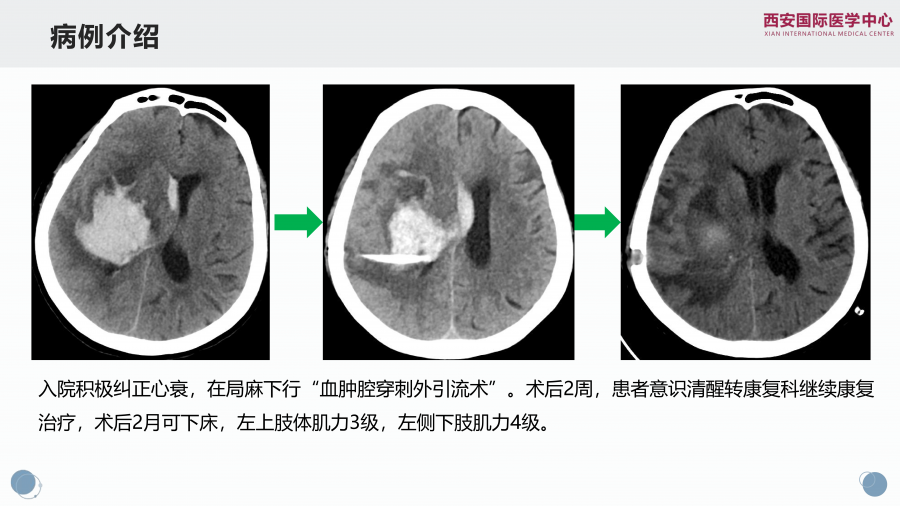 脑出血合并心衰一例谈目标导向液体治疗策略_03.png