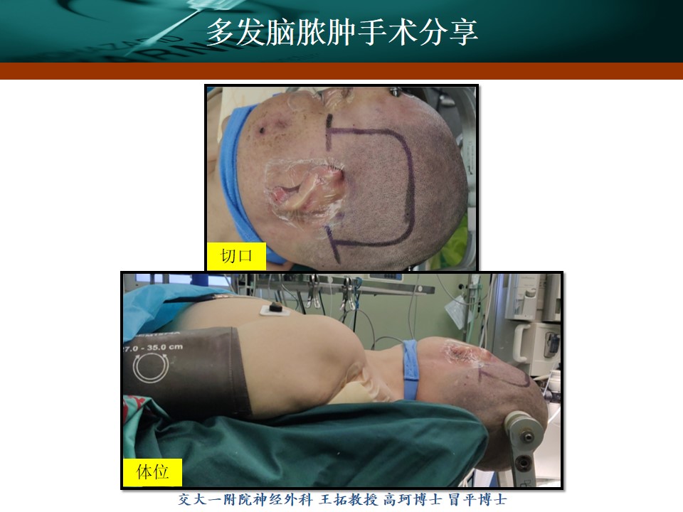 王拓教授团队一例左侧颞叶多发脑脓肿手术分享