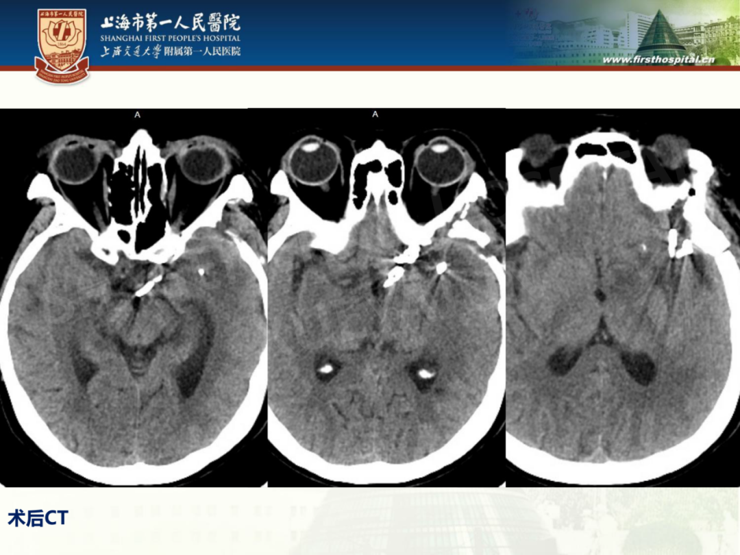 谢万福教授团队手术分享第1期：颅内多发动脉瘤夹闭手术 - 脑医汇 - 神外资讯 - 神介资讯