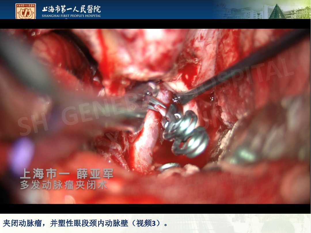 上海市第一人民医院薛亚军颅内多发动脉瘤开颅夹闭术一例
