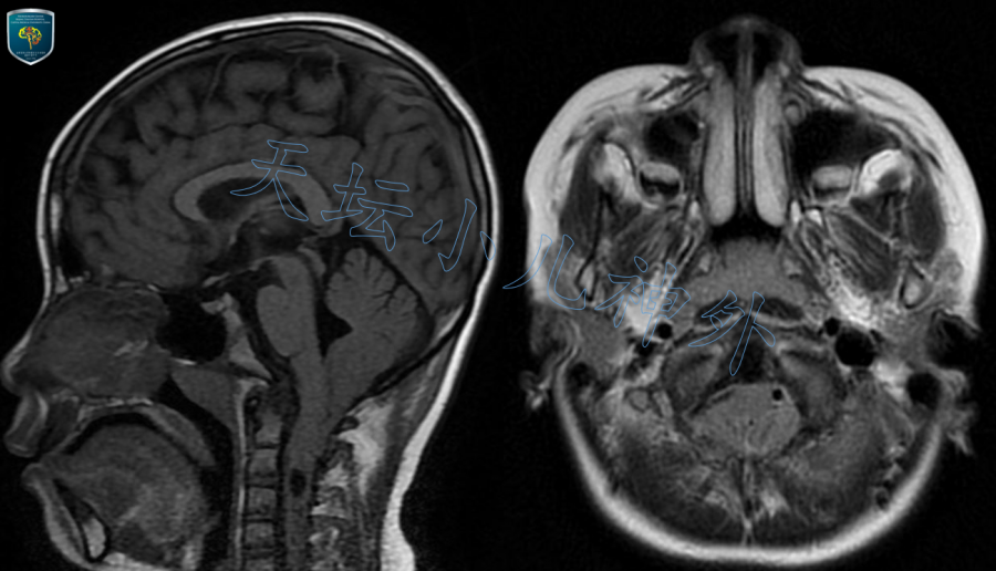 小脑扁桃体下疝ct图片图片