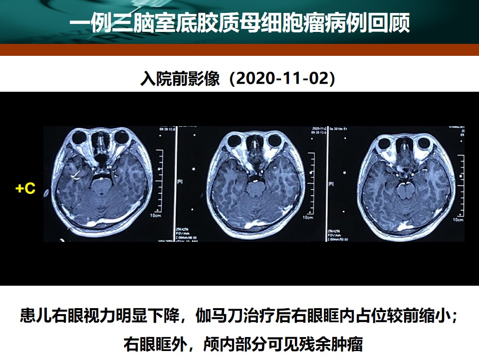 三脑室肿瘤图片