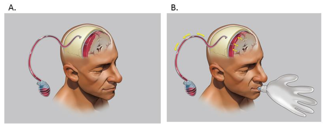 慢性硬膜下血腫(chronic subdural hematoma,csdh)術後複發率5%-30%.