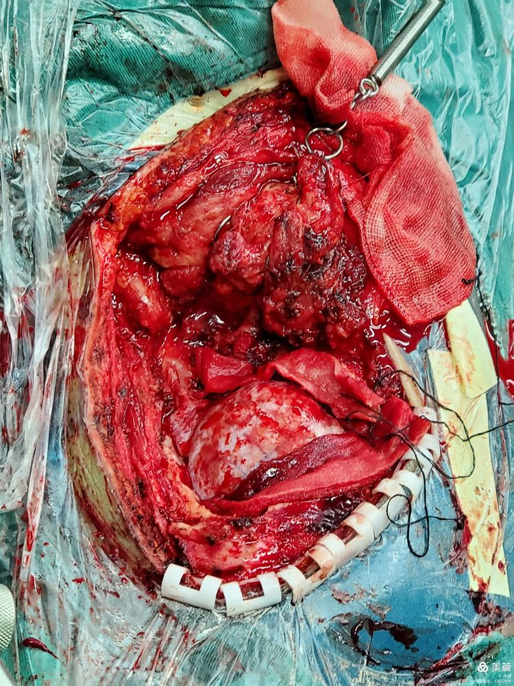 基础远外侧入路切除枕大孔区肿瘤