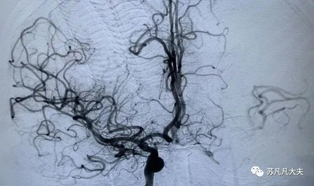 右侧大脑中动脉重度狭窄血管内治疗一例 