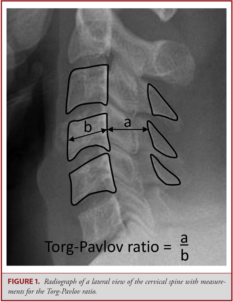 figure2 图a矢状位可见最小狭窄节段椎管直径1; 图b 轴位脊髓面积2