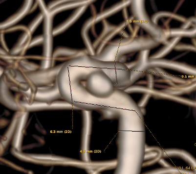 颈动脉瘤支架图片