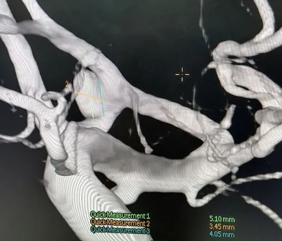 宽颈前交通动脉瘤的支架辅助弹簧圈栓塞