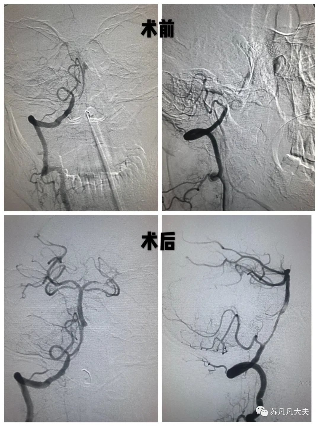 基底动脉闭塞开通一例