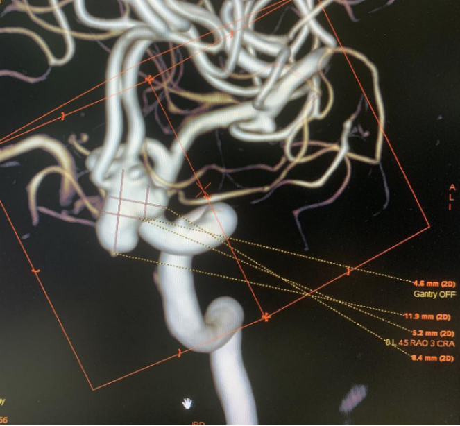 atlas支架结合双微导管辅助弹簧圈栓塞宽颈动脉瘤2例