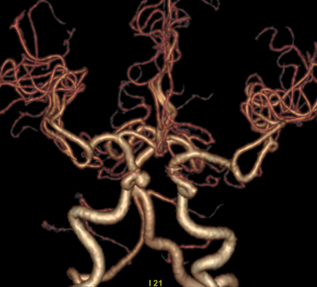 代成波：急性颈动脉闭塞的血管内治疗 -- 严道脑血管网